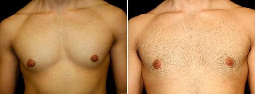 before and after of gynecomastia patient