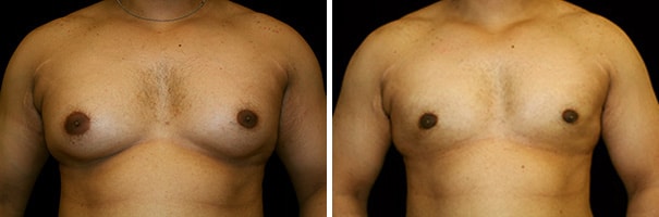 gynecomastia reduction surgery before and after photos
