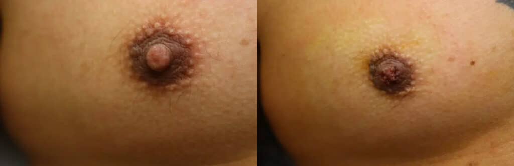 Male nipple surgery before and after photos