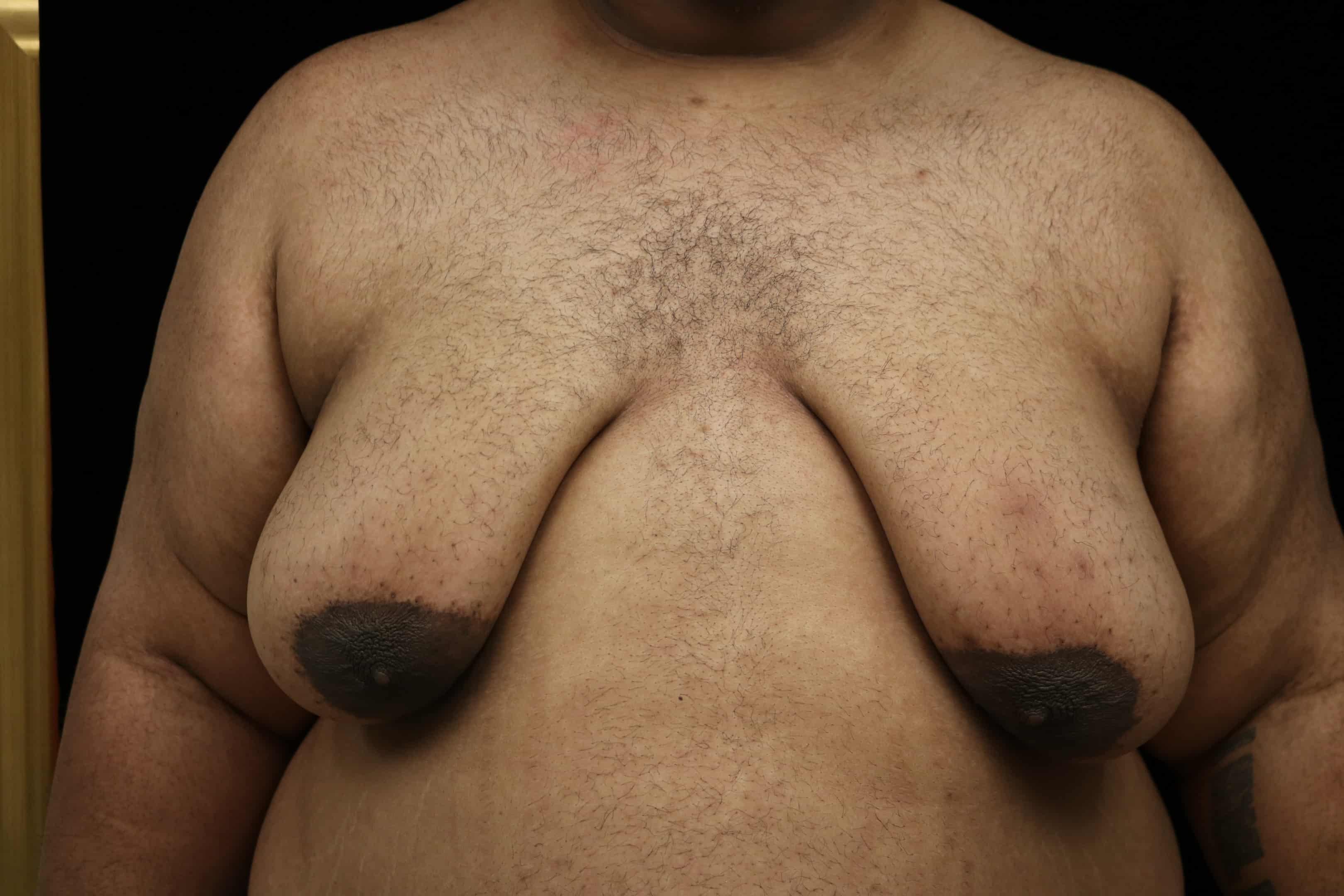 Men experiencing chest fat loss and skin laxity after using semaglutide.