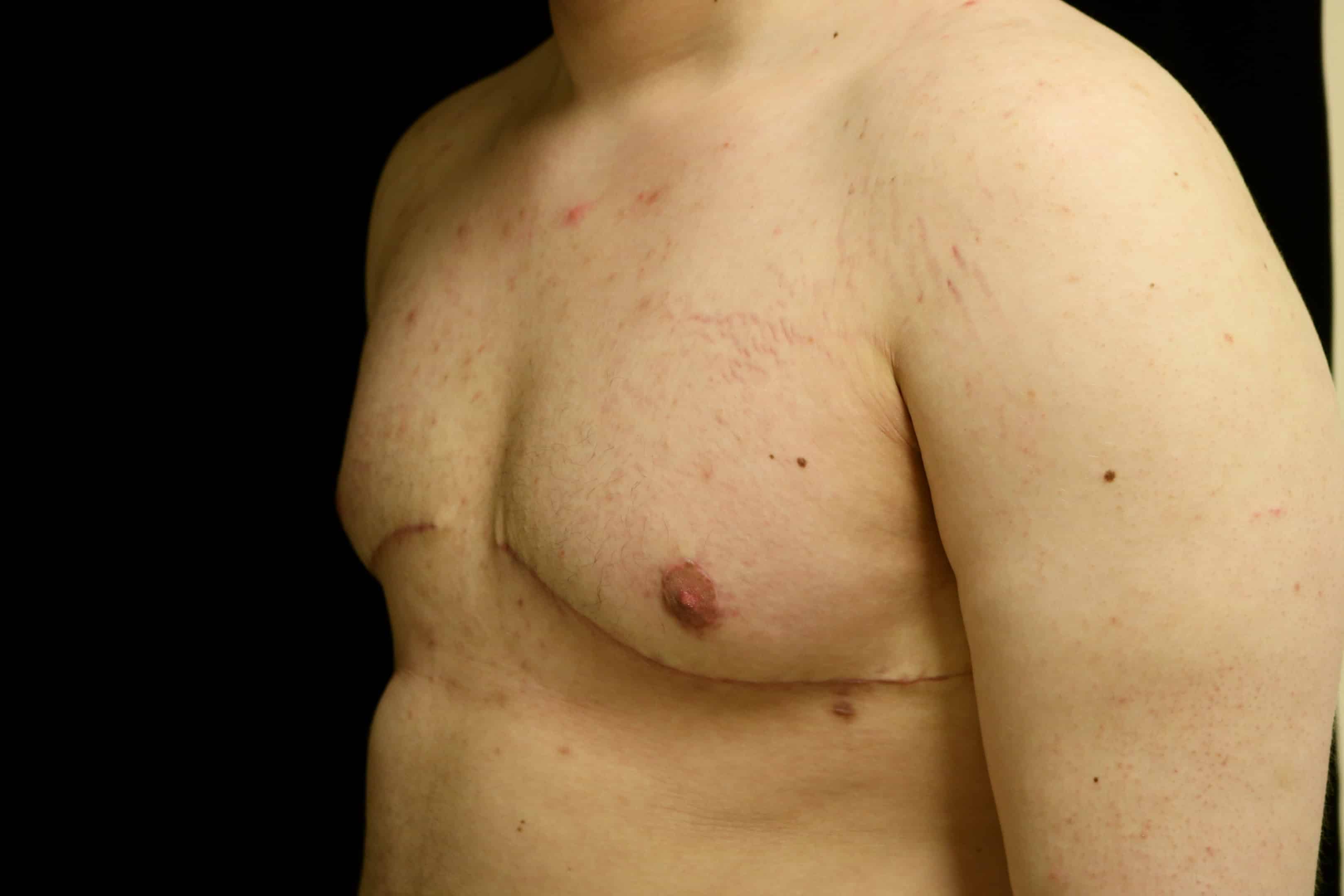 Same patient after a double incision mastectomy with a free nipple graft at 3 months.