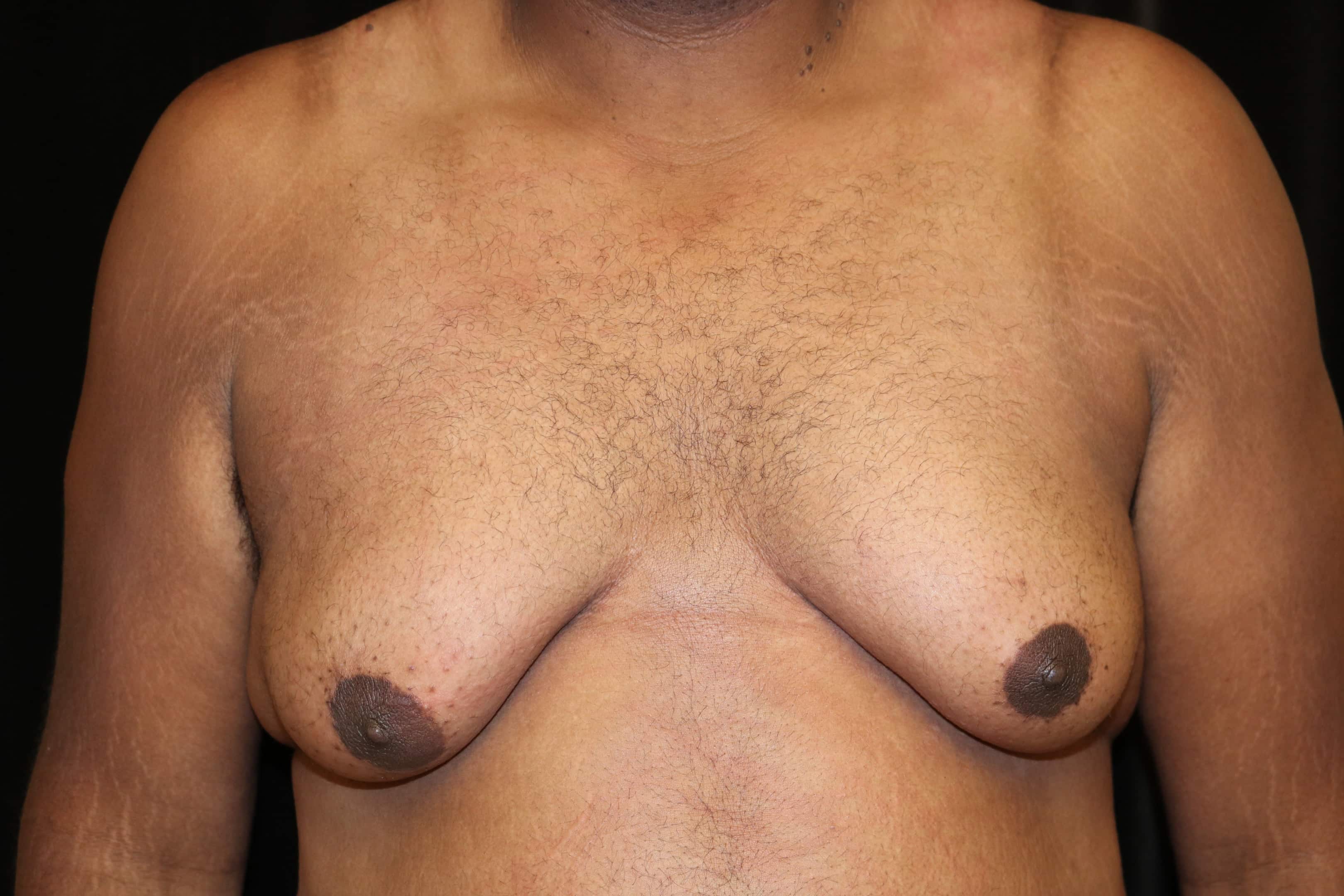 Illustration of a patient of Dr.Delgado with gynecomastia and skin laxity after significant weight loss.
