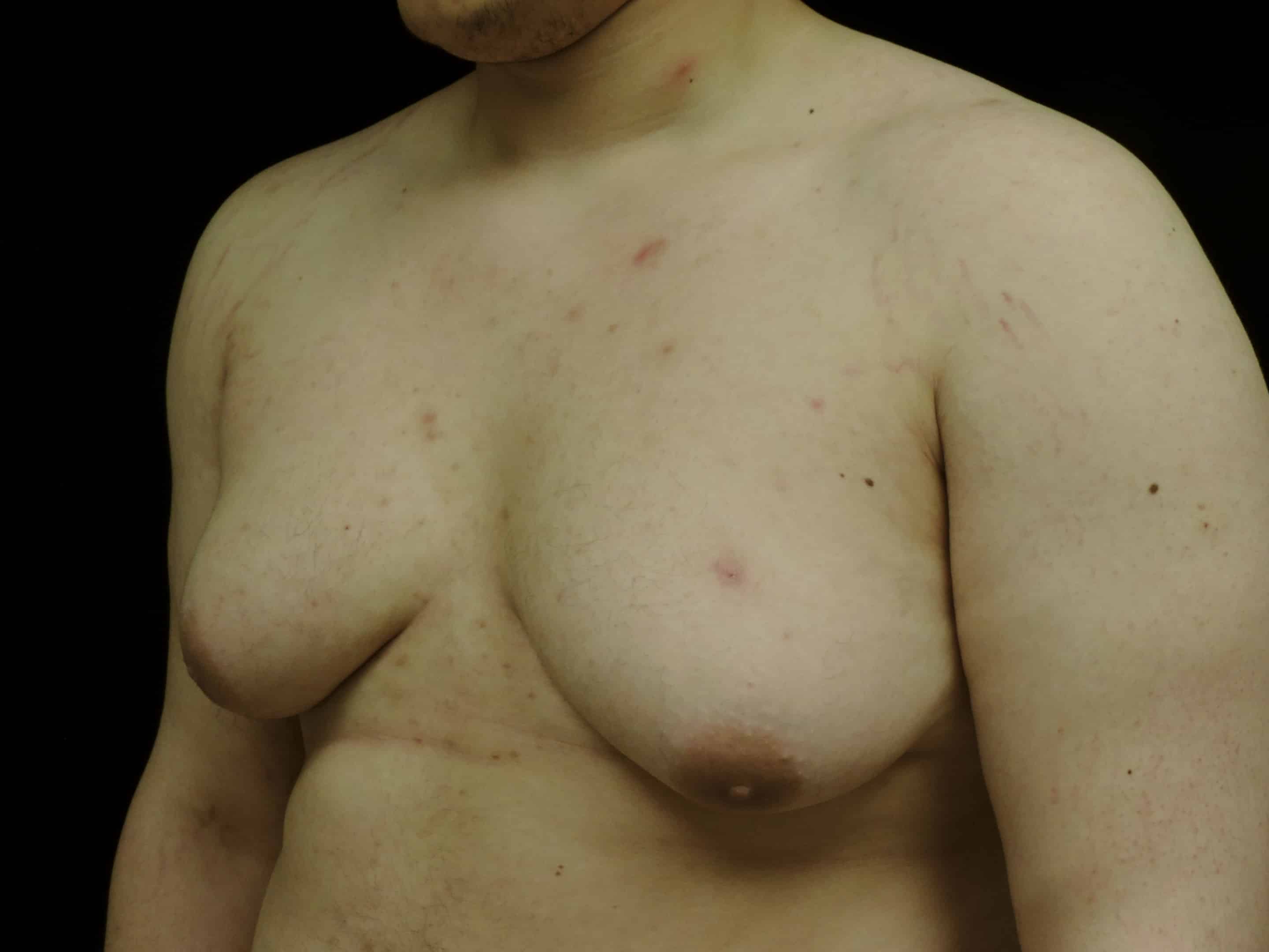 A patient of Dr. Delgado with gynecomastia and skin laxity after weight loss.
