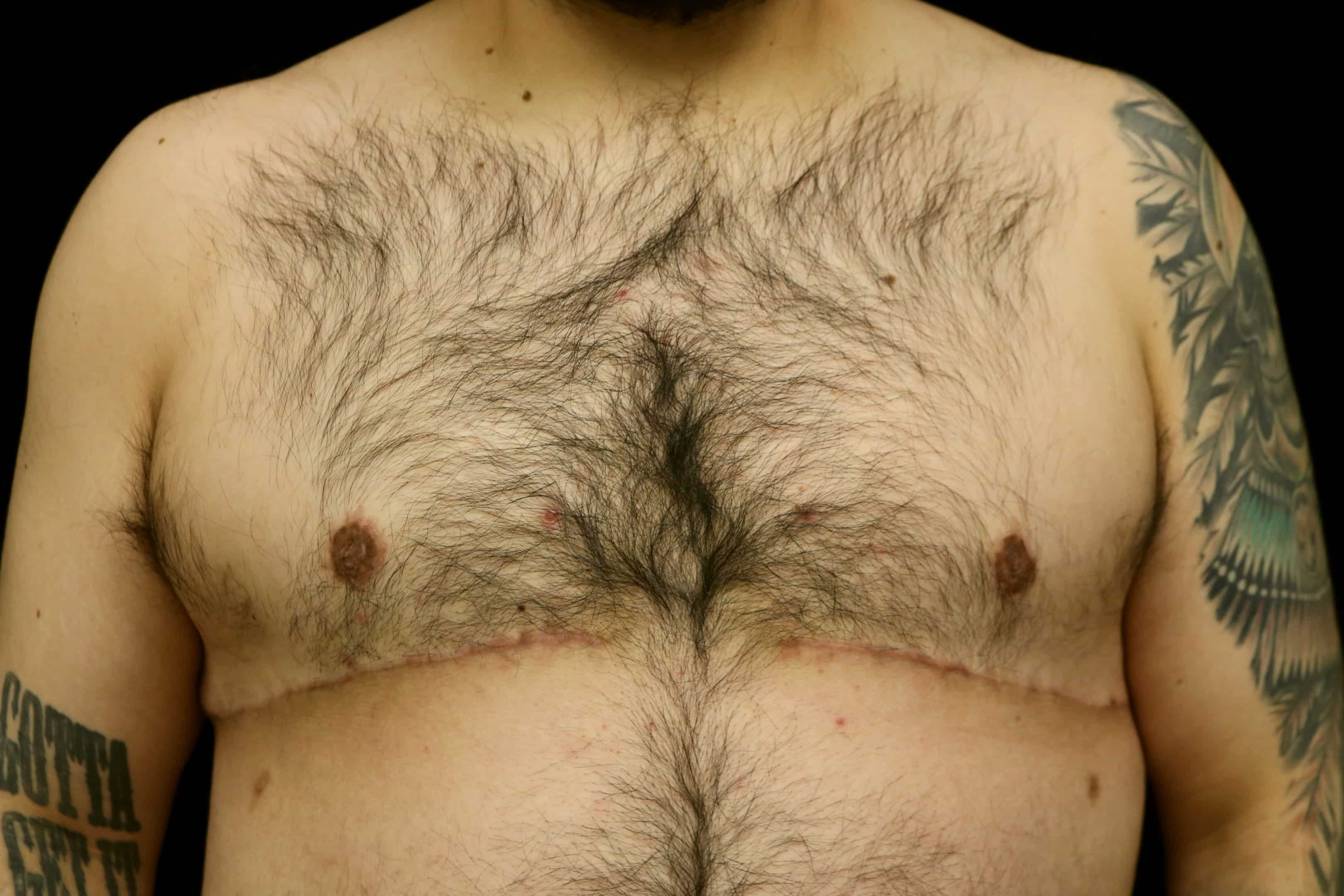 Same patient after a double incision mastectomy with a free nipple graft.