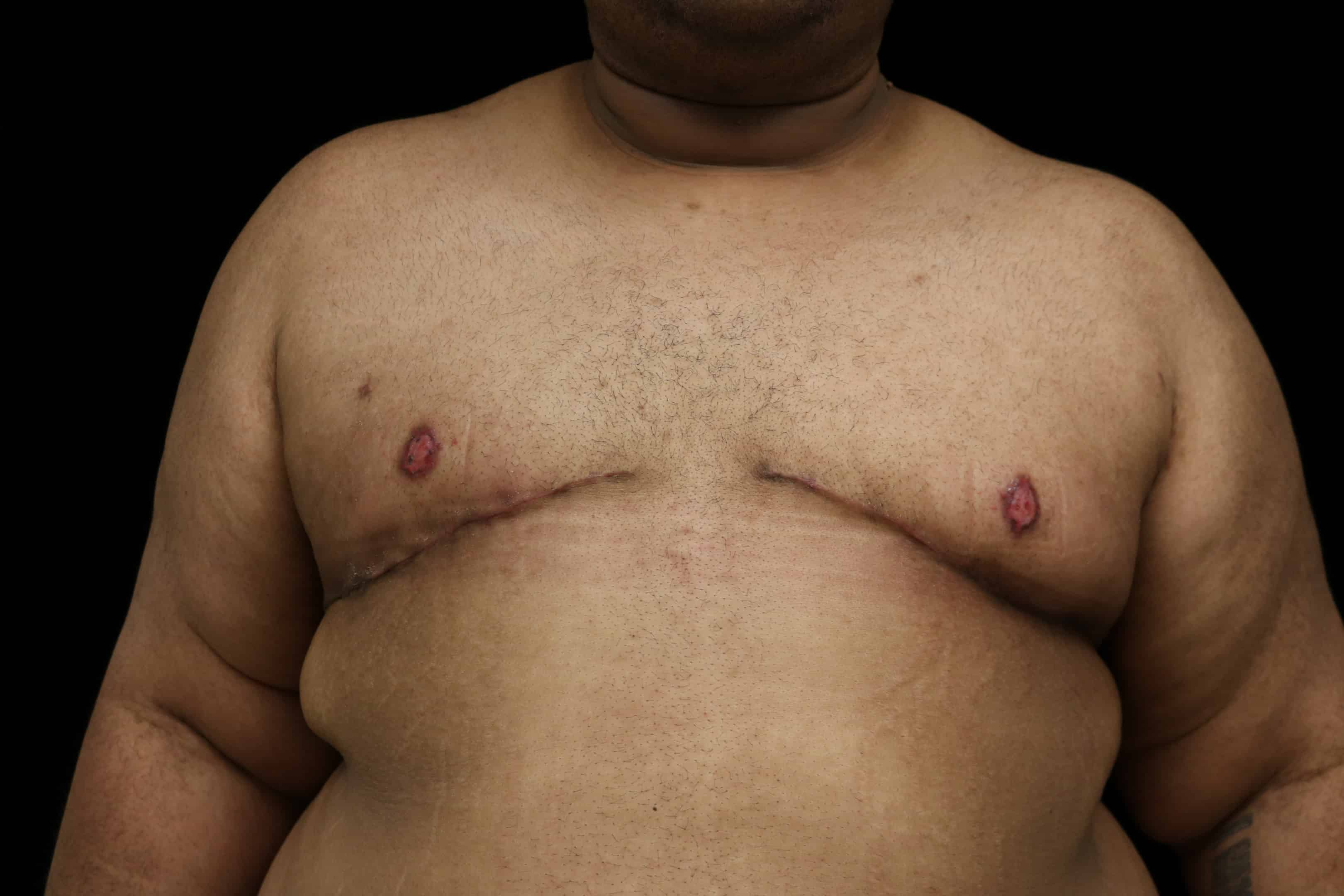         After double incision mastectomy and free-nipple graft.