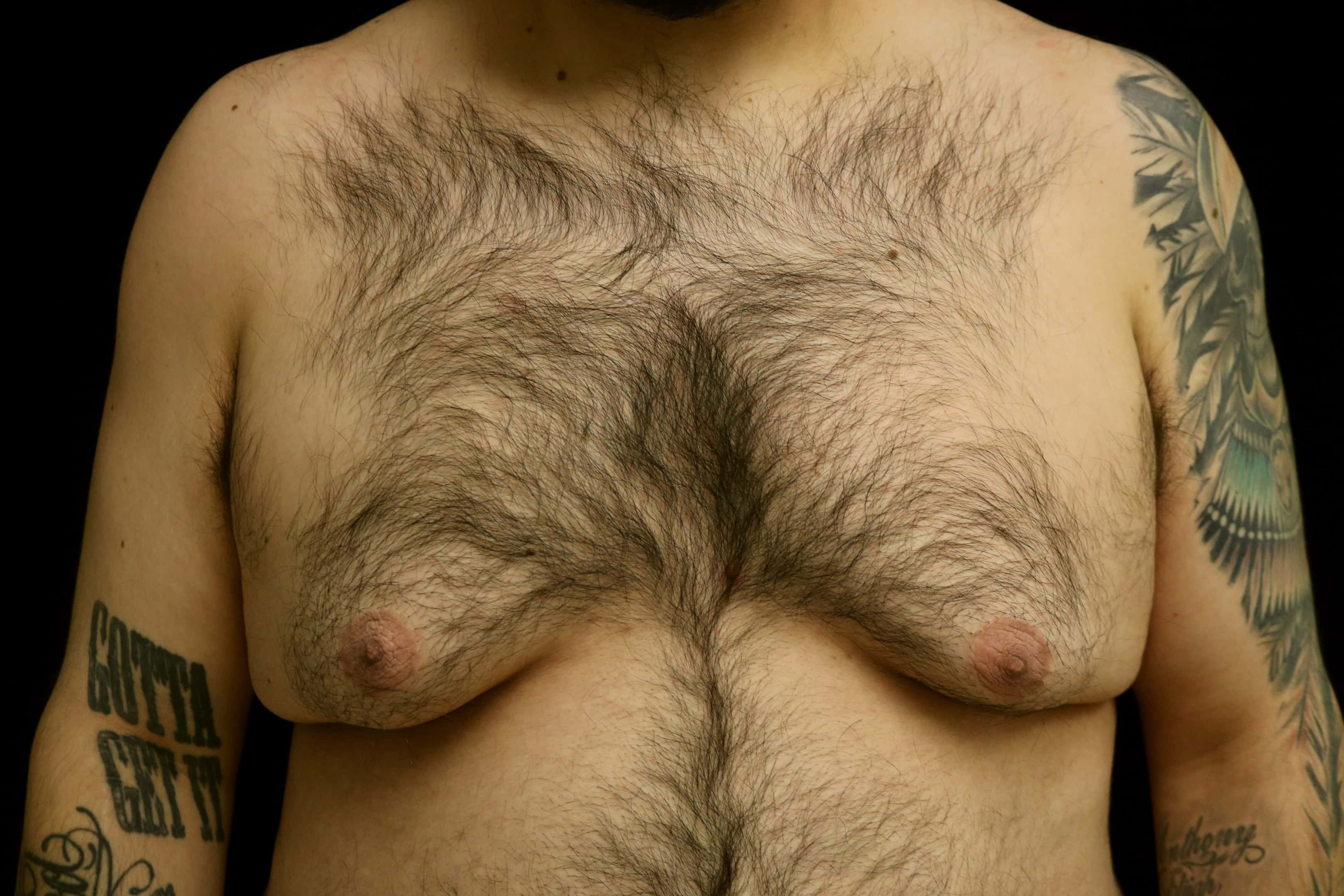 A patient of Dr. Delgado with gynecomastia and skin laxity after weight loss.