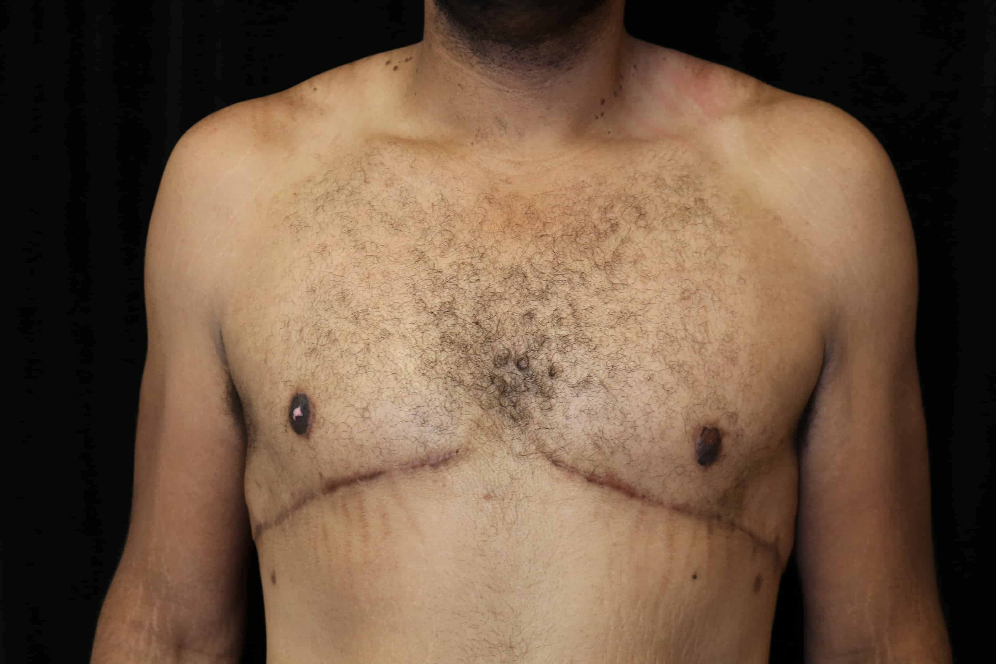 Same patient after a double incision mastectomy with a free nipple graft at 4 months.