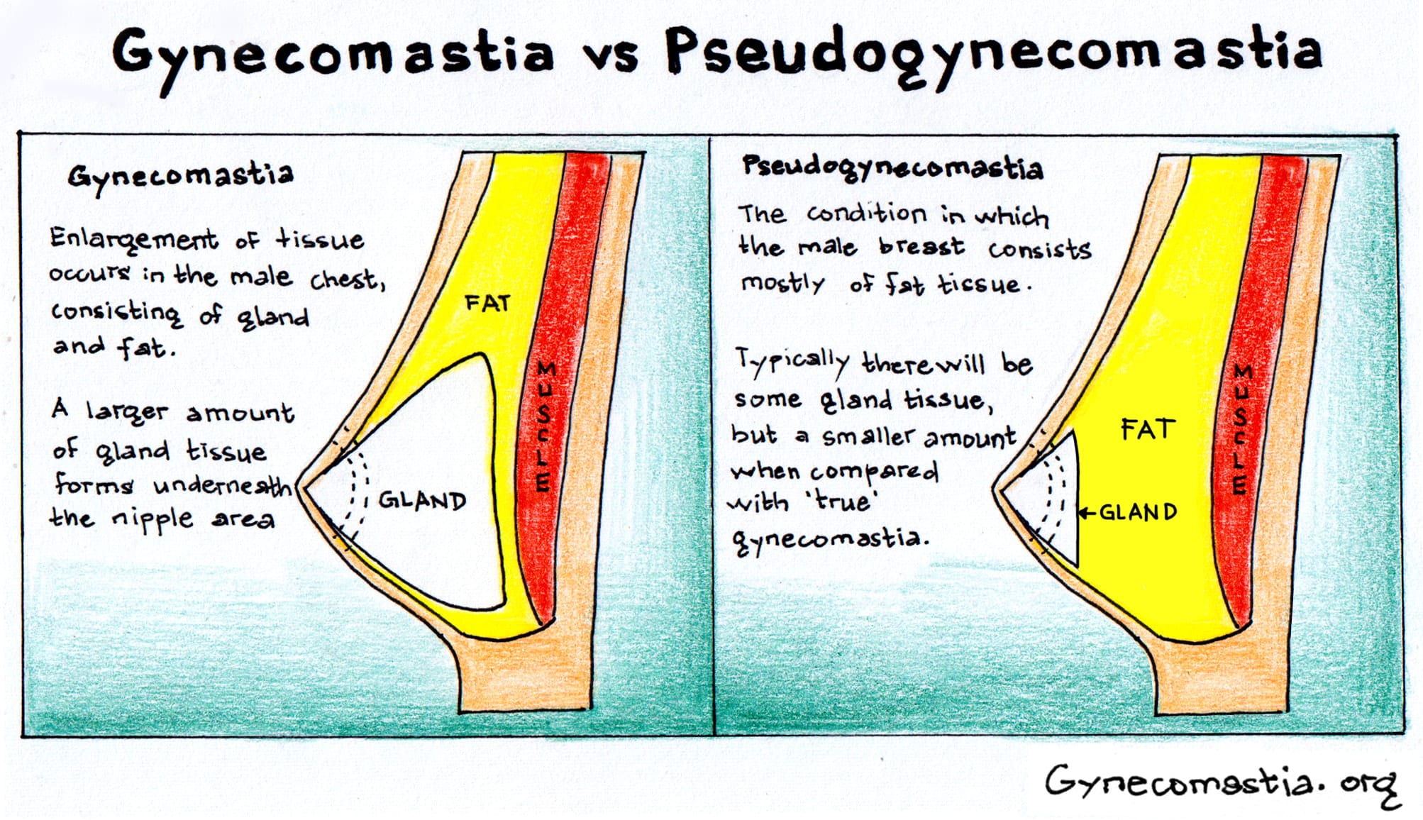 Diagrams comparing gynecomastia to pseudogynecomastia.