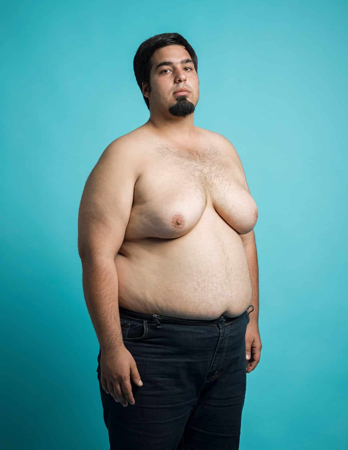 A man with pseudogynecomastia.