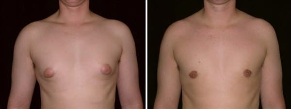 A surgical setup for gynecomastia surgery, showcasing tools and equipment used in treatment options.