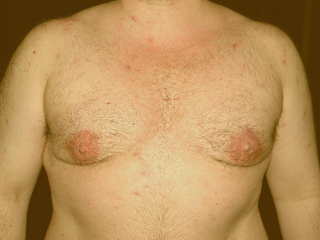 The patient after Stage 1 male breast reduction - Breast gland excision and liposuction.