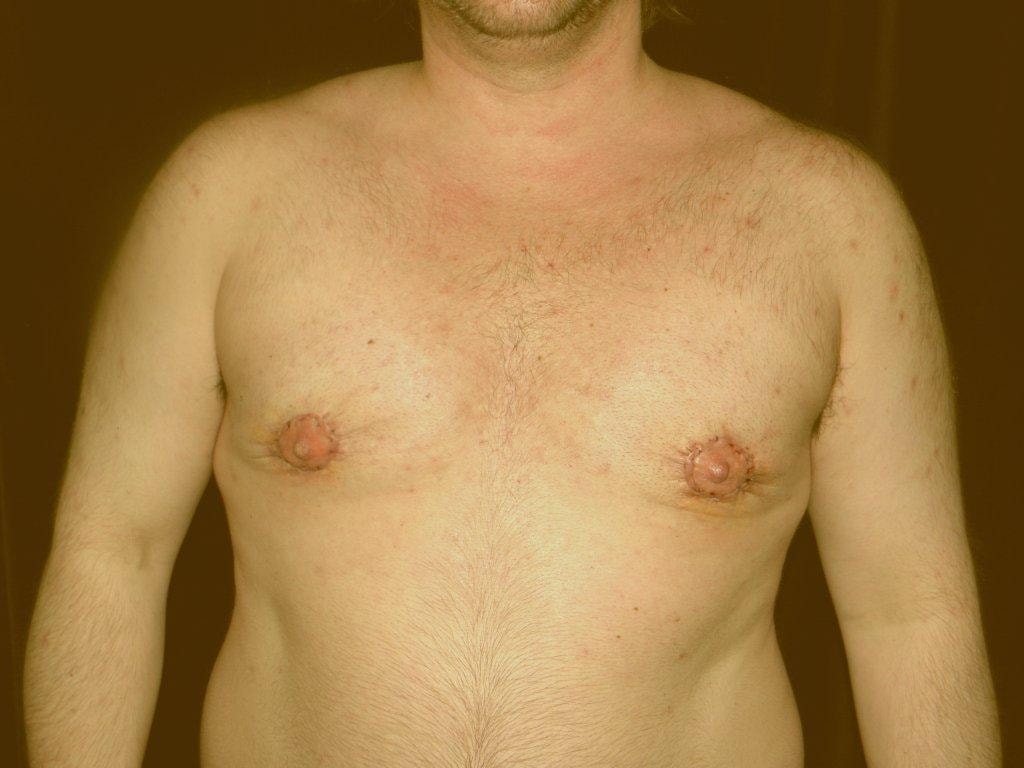 The patient after Stage 2 - peri-areola skin excision to reduce loose skin.