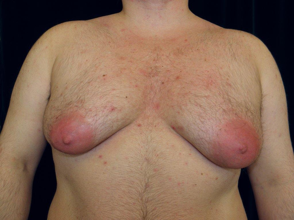 Our patient's pre-op photos at 18 years old