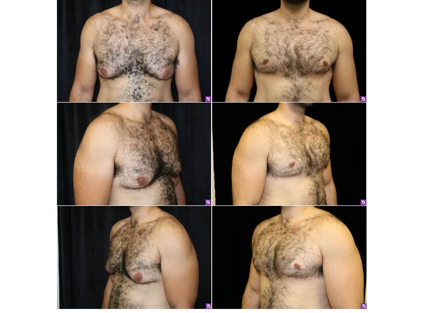 before and after of gynecomastia patient