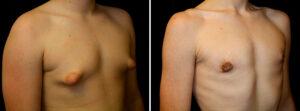 Patient of Dr. Delgado with puffy nipples and the after photo.